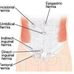 hernia-repair