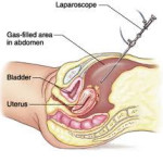 Laparoscopy