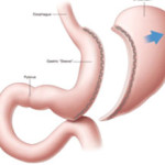 Bariatric Surgery