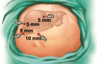 Gall Bladder