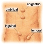 <h1 align="center"><strong>PATIENT  INFORMATION FOR LAPAROSCOPIC REPAIR OF HERNIA [INGUINAL/FEMORAL/UMBILICAL/EPIGASTRIC/INCISIONAL]</strong></h1> <ul>   <li><strong><a href="#1">WHAT IS A HERNIA?</a></strong></li>   <li><strong><a href="#2">HOW DO I KNOW IF I HAVE A HERNIA?</a></strong></li>   <li><strong><a href="#3">WHAT CAUSES A HERNIA?</a></strong></li>   <li><strong><a href="#4">HOW IS HERNIA TREATED?</a></strong><a href="#4"> </a></li>   <li><strong><a href="#5">WHAT IS A MESH?</a></strong></li>   <li><strong><a href="#6">WHAT SHOULD I EXPECT AFTER  SURGERY?</a></strong></li>   <li><strong><a href="#7">IS IT RISKY FOR  PEOPLE WITH OTHER MEDICAL PROBLEMS LIKE DIABETES, HYPERTENSION & MORBID  OBESITY?</a></strong></li>   <li><strong><a href="#8">WHAT  ARE THE OTHER PROCEDURES THAT CAN BE DONE LAPAROSCOPICALLY?</a></strong></li> </ul> <p><strong><a name="1" id="1"></a>WHAT IS A HERNIA?</strong></p> <ul type="disc">   <li>A hernia occurs when the inside layers of the abdominal       muscle have weakened, resulting in a bulge or tear. In the same way that       an inner tube pushes through a damaged tire, the inner lining of the       abdomen pushes through the weakened area of the abdominal wall to form a       small balloon-like sac.<strong> </strong></li>   <li>Both men and women can get a hernia. </li>   <li>You may be born with a hernia       (congenital) or develop one over time. </li>   <li>A hernia does not get better over time,       nor will it go away by itself.</li> </ul> <p><strong><a name="2" id="2"></a>HOW DO I KNOW IF I HAVE A HERNIA?</strong></p> <ul>   <li>The common areas where hernias occur are in the groin (inguinal),  belly button (umbilical), and the site of a previous operation (incisional). </li> </ul> <ul type="disc">   <li>You may notice a bulge under the skin.       You may feel pain when you lift heavy objects, cough, strain during       urination or <strong><u>daefecation</u></strong>,       or during prolonged standing or sitting.</li>   <li>Severe, continuous pain, redness, and       tenderness are signs that the hernia may be entrapped or strangulated.       These symptoms are cause <strong><u>of</u></strong> concern and <strong><u>warrant </u></strong>immediate       contact <strong><u>with</u></strong> your       physician or surgeon. </li>   <li>Bulge may disappear on lying down.</li> </ul> <p><a name="3" id="3"></a><strong>WHAT CAUSES A HERNIA?</strong> <br />   The wall of the abdomen  has natural areas of potential weakness. Hernias can develop at these or other  areas due to heavy strain on the abdominal wall, ageing, injury, an old  incision or a weakness present from birth. Anyone can develop a hernia at any  age. Most hernias in children are congenital. In adults, a natural weakness or  strain from heavy lifting, persistent coughing, difficulty with bowel movements  or urination can cause the abdominal wall to weaken or separate.</p> <p><strong>TYPES OF  HERNIA</strong></p> <ul type="square">   <li><strong>Inguinal       hernia             -  </strong>as shown in Fig 1<strong>                 </strong></li> </ul> <ul type="square">   <li><strong>Femoral       Hernia            -  </strong>as shown in Fig 1<strong>                       </strong><br />   </li> </ul> <p><strong>Other Hernias <br />   1. <u>Incisional</u></strong><u>-</u>It arises in the abdominal wall where  a previous surgical incision was made  In  this area the abdominal muscles have weakened; this results in a bulge or a tear.  This can allow a loop of intestines or other abdominal contents to push into  the sac. Incisional hernias occur in people who have had previous abdominal  surgery, and are more likely to occur in people who are obese or pregnant .Incisional  hernias are caused by thinning or stretching of scar tissue that forms after  surgery. This weakened scar tissue then creates a weakness in the abdominal  wall.       <br />   2. <strong>U<u>mbilical</u></strong><u>-</u> An  umbilical hernia is a condition in which a defect or hole exists in the  abdominal wall at the level of the umbilicus  (belly button). It   commonly is  found in neonates (babies). <em>Shown in Fig 1</em><strong> </strong><br />   <strong>3. <u>Epigastric</u></strong>-An epigastric hernia is a <a href="http://en.wikipedia.org/wiki/Hernia" title="Hernia">hernia</a> in the epigastric region of a human. Typically  there is a small defect of the <a href="http://en.wikipedia.org/wiki/Linea_alba" title="Linea alba">linea alba</a> between  the <a href="http://en.wikipedia.org/wiki/Rectus_abdominis" title="Rectus abdominis">rectus abdominis</a> muscles. This allows tissue from inside the abdomen to herniate anteriorly. (Shown in Fig 1 )<strong> </strong><br /> </p> <p><strong><a name="4" id="4"></a>HOW IS HERNIA TREATED?</strong><strong> </strong></p> <ul type="disc">   <li>Hernias       usually need to be surgically repaired to prevent intestinal damage and       further complications.</li>   <li>Use       of a truss {hernia belt} is usually ineffective.</li>   <li>Surgical       procedures are done in one of the two fashions:-Your surgeon will       determine the best method of repair for individual situation:-</li>   <ul type="square">     <li> <strong><u>The open approach</u></strong> is done from        the outside through a three or four         inch long incision in the groin. The surgeon may choose to use a        small piece of surgical mesh to repair the defect.<strong></strong></li>   </ul> </ul> <p><strong><u>The laparoscopic hernia repair</u></strong>. In        this approach, a laparoscope (a tiny telescope) connected to a special        camera is inserted through a trocar, a small hollow tube, allowing the        surgeon to view the hernia and surrounding tissue on a video screen.        Other trocars are inserted which allow your surgeon to work        "inside."   Three or four quarter inch incisions are        usually necessary.  The hernia is        repaired from behind the abdominal wall.     A small piece of surgical mesh is        placed over the hernia defect and held in place with small surgical        staples.  This operation is usually        performed with general anesthesia or occasionally using regional or        spinal anesthesia  </p> <p><strong>ARE YOU A CANDIDATE FOR  LAPAROSCOPIC HERNIA REPAIR?</strong> <br />   Only after a thorough  examination can your surgeon determine whether laparoscopic hernia repair is  right for you. The procedure may not be best for some patients who have had  previous abdominal surgery or underlying severe medical conditions.<br /> </p> <p><strong><a name="5" id="5"></a>WHAT IS A MESH?</strong> </p> <ul type="disc">   <li><em><u>MESH</u></em> Surgical material, made from synthetic plastic (i.e: <a href="http://www.hernia.com/mesh_def.html" target="_blank">Polypropylene</a>) or gortex) or even       biodegradable substances, used to repair hernias. These sterile mesh       "SCREENS", or "PATCHES" are soft, pliable, flexible,       and 'wafer - thin' so as to conform to body movement and size. Yet they       are remarkably strong to immediately add strength and fully repair the       hernia while allowing rapid resumption of "Normal" activities,       including <a href="http://hernia.tripod.com/faqs.html#k" target="_blank">SPORTS</a>. Many varieties, shapes and sizes of <a href="http://members.tripod.com/~hernia/meshsyst.html" target="_blank">Mesh Systems</a> are available. Hernias differ       from patient to patient, and we firmly believe that any given single mesh       system or manufacturer is not appropriate for effective repair of all       hernias. We therefore evaluate the anatomic and physical properties of       each hernia at the time of surgery, then use our expertise to select the       appropriate mesh form and <a href="http://hernia.tripod.com/vocab2.html#TENS#TENS" target="_blank">TENSION FREE TECHNIQUE</a> to satisfactorily       repair your hernia defect appropriately. </li> </ul> <p><strong><a name="6" id="6"></a>WHAT SHOULD I EXPECT AFTER  SURGERY?</strong> </p> <ul type="disc">   <li>Following the operation, you will be       transferred to the recovery room where you will be monitored for 1-2 hours       until you are fully awake. </li>   <li>With any hernia operation, you can       expect some soreness mostly during the first 24 to 48 hours. </li>   <li>You are encouraged to be up and about       the day after surgery. </li>   <li>With laparoscopic hernia repair, you       will probably be able to get back to your normal activities within a few days.       These activities include showering, driving, climbing stairs, lifting,       working and engaging in sexual intercourse. </li>   <li>A follow-up appointment within a week       after your operation is scheduled. </li>   <li>Strenuous activity and exercise are       restricted for 2 to 4 weeks after surgery.</li> </ul> <p><strong><a name="7" id="7"></a>IS IT RISKY FOR  PEOPLE WITH OTHER MEDICAL PROBLEMS LIKE DIABETES, HYPERTENSION & MORBID  OBESITY?</strong></p> <ul type="disc">   <li>Not       at all. On the contrary, absence of major trauma to the body causes       minimal disturbance of normal physiology. Hence, there is no risk of aggravation       of other conditions.</li> </ul> <p><strong><a name="8" id="8"></a>WHAT  ARE THE OTHER PROCEDURES THAT CAN BE DONE LAPAROSCOPICALLY?</strong><br />   Almost every organ in the human body has  become accessible to the surgeon and MAS can be applied to most of the surgical  procedures. Some of the conditions for which Minimally Access Surgeries are  commonly performed are:-</p> <ul type="disc">   <li>Abdomen       - Gall bladder stones, Appendicitis, Gastro – intestinal ulcers, Colorectal       Surgeries, Splenectomy.<strong></strong></li>   <li>Hernias – Inguinal,       Umbilical, Epigastric, Femoral& Incisional.<strong></strong></li>   <li>Urinary       System- Urinary stones, Enlarged prostate, Kidney & Bladder tumors.<strong></strong></li>   <li>Bones & joints </li>   <li>Chest – VATS for empyema, decortication and       Sympathectomy. </li> </ul>