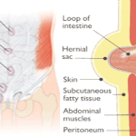 Hernia